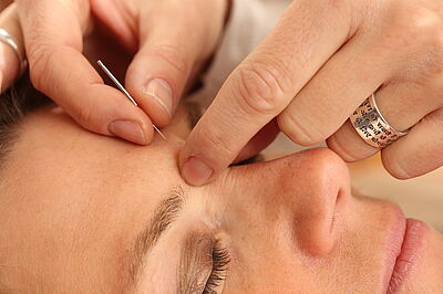 Akupunktur bei Kopfschmerzen